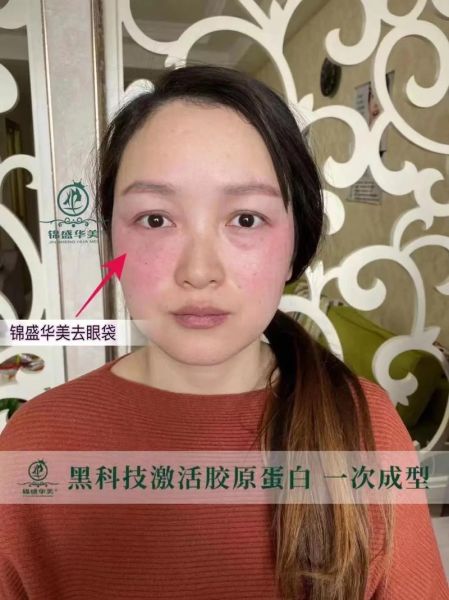 30秒去眼袋黑科技有用吗_效果能维持多久
